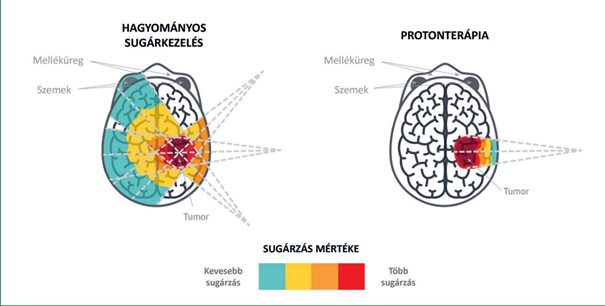 hadronterapia